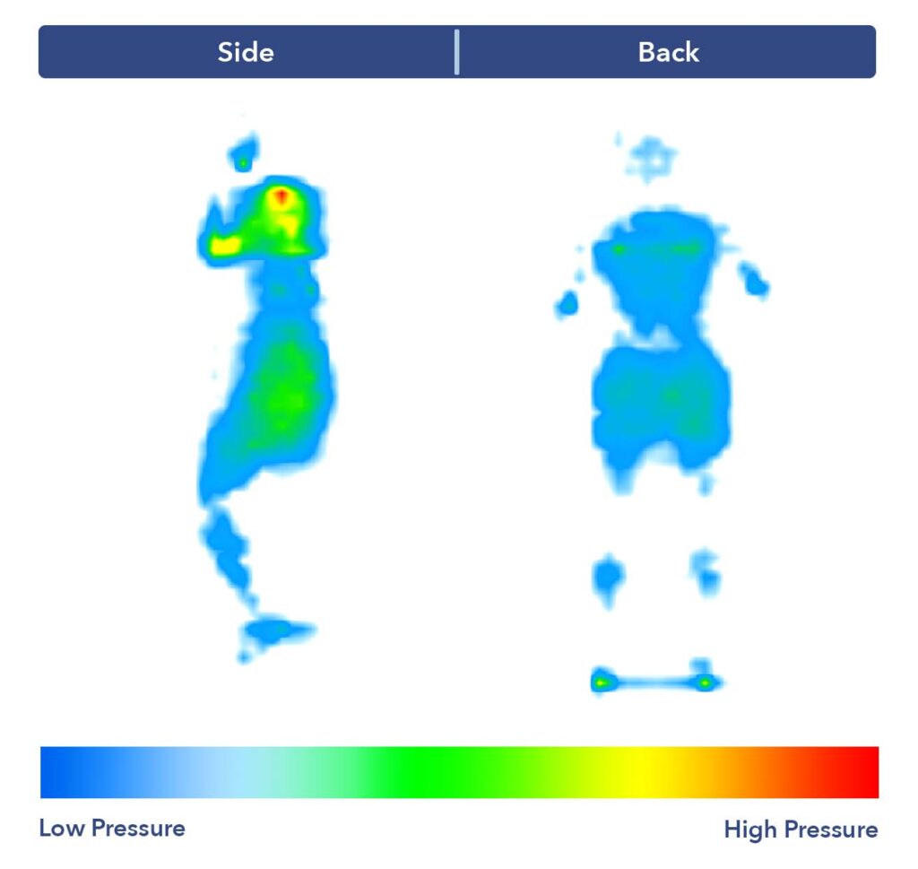 Side-by-side images of our pressure map. It shows a thermal graphic of someone lying on their side and their back. For this map, there's a patch of yellow and red at the shoulders, indicating high pressure buildup.