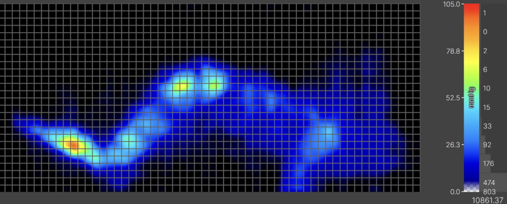 Our pressure map for the Saatva. It shows a thermal graphic of an average-weight sleeper lying on their side. The map is mostly blue, with some flares of yellow at the hips, indicating moderate pressure buildup in this area.